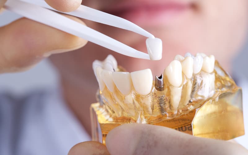 dental implants in york