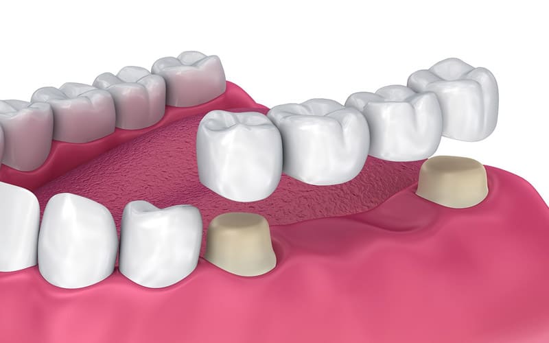 dental bridges in york