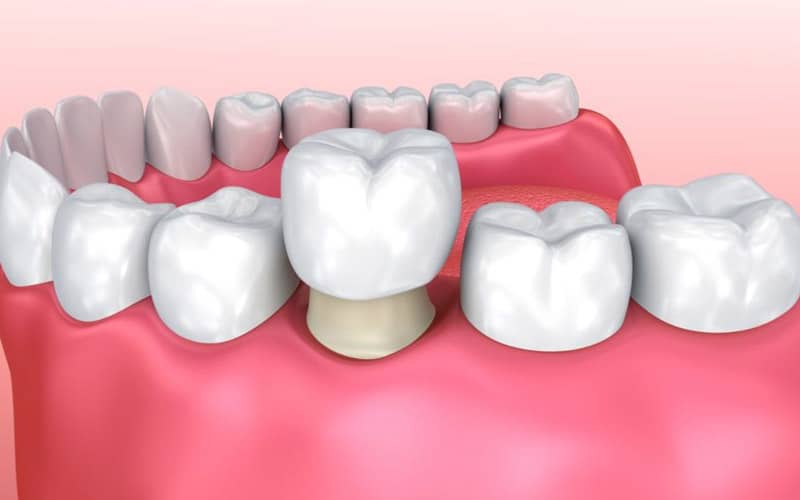 dental crowns in york