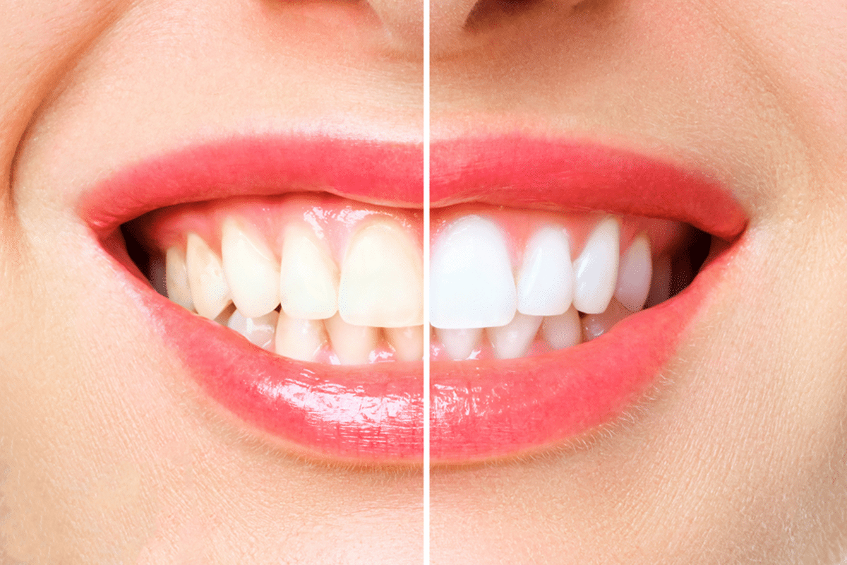7 things to know before you whiten your teeth