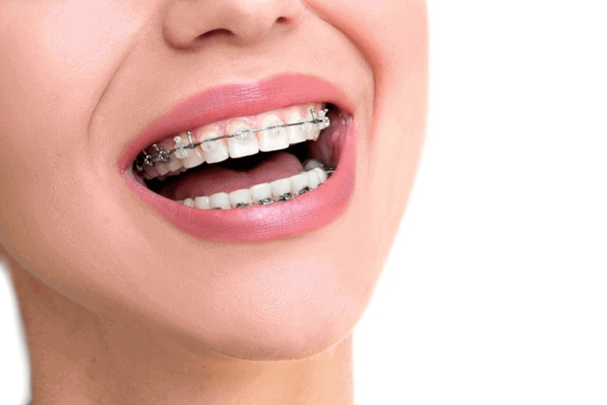 preventing bad breath while wearing braces