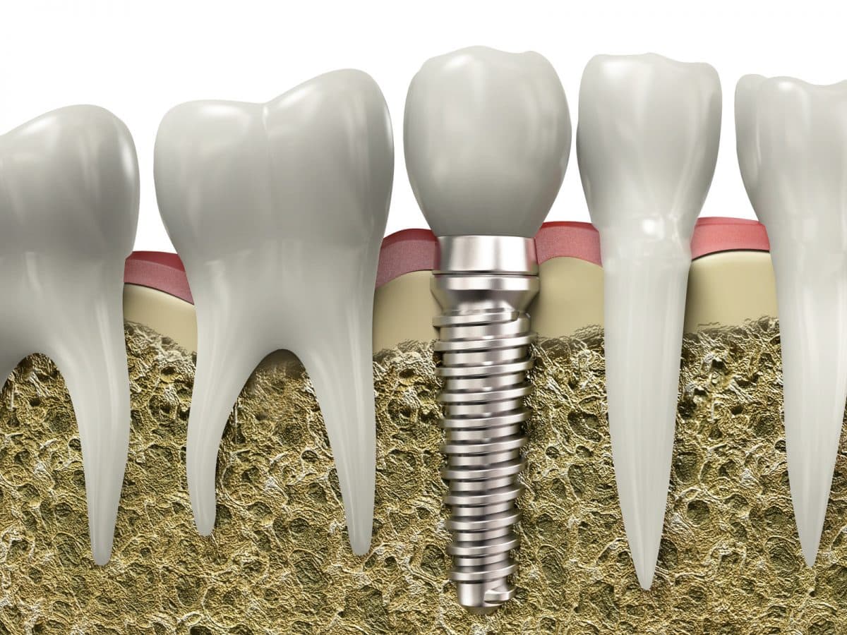 how to care for your implant to avoid peri implantitis