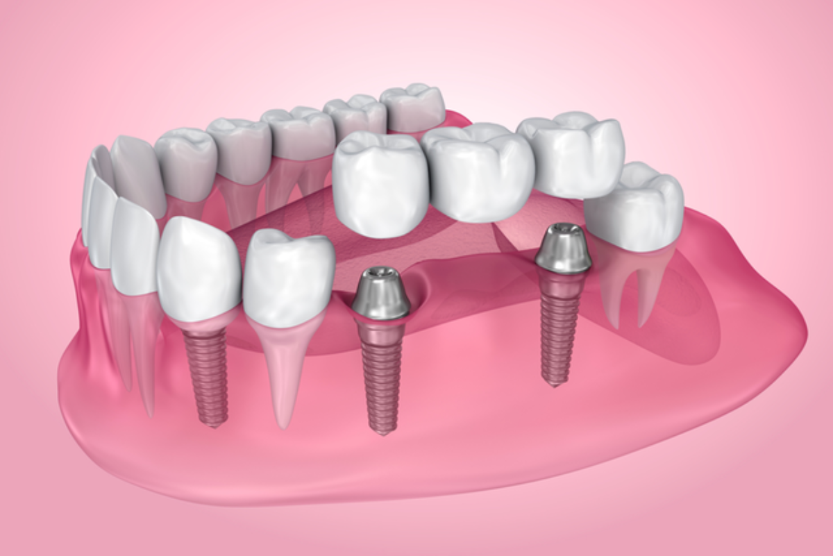 benefits of dental bridges