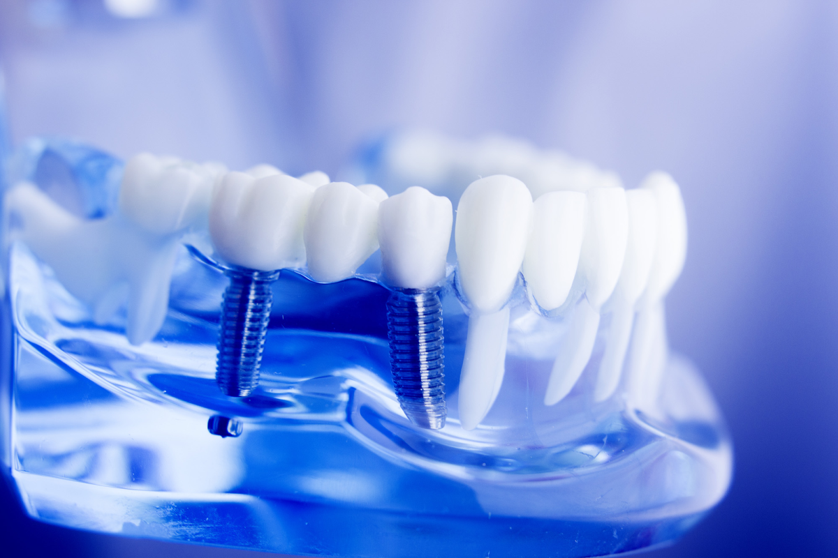 the 4 attributes of dental implants explained