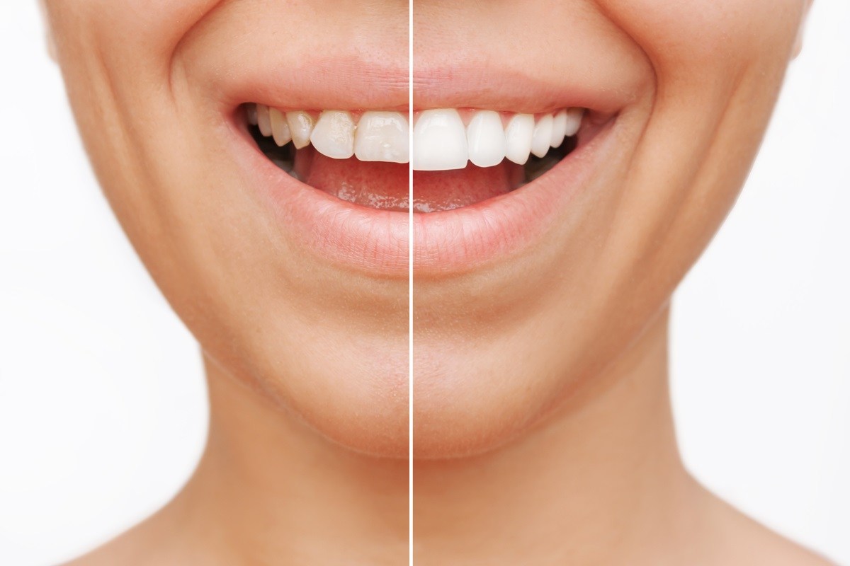 the top 10 questions answered about porcelain veneers