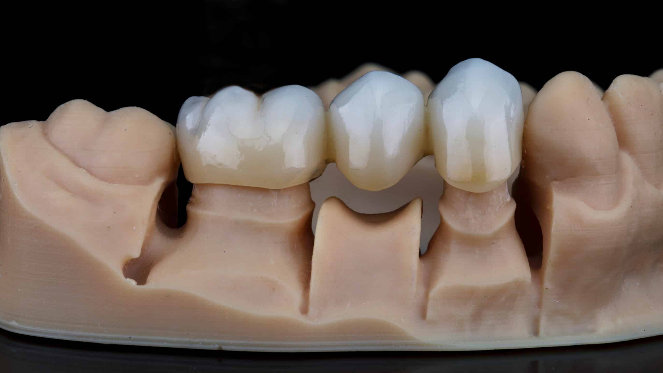 Can Dental Bridges Improve Speech and Chewing