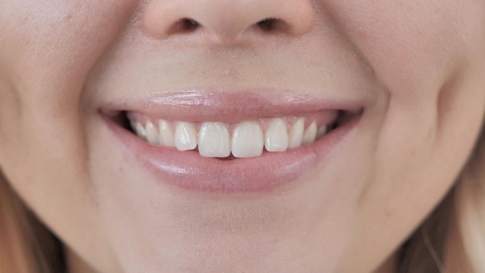 Dental Contouring for a More Symmetrical Smile