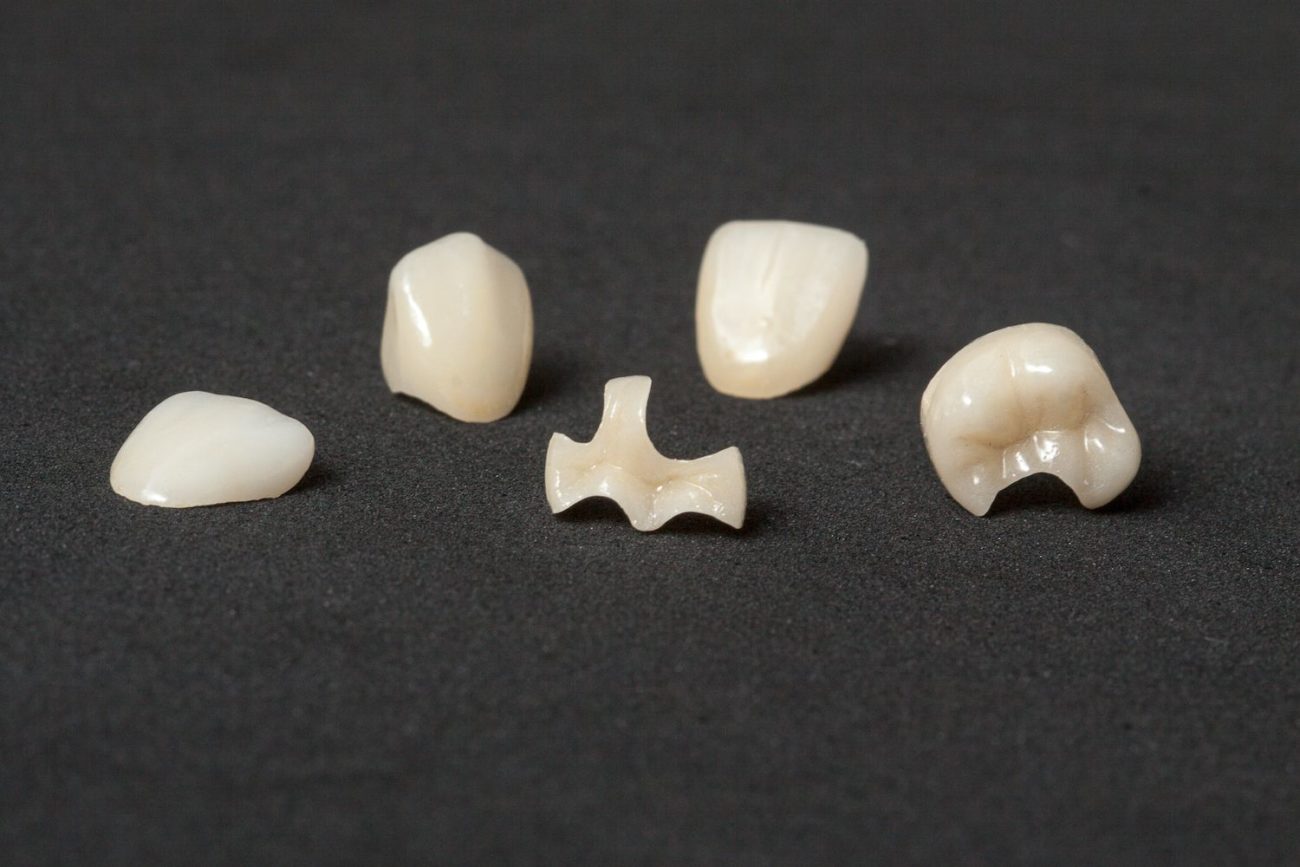 Inlays vs Onlays: Choosing the Right Tooth-Conserving Restoration