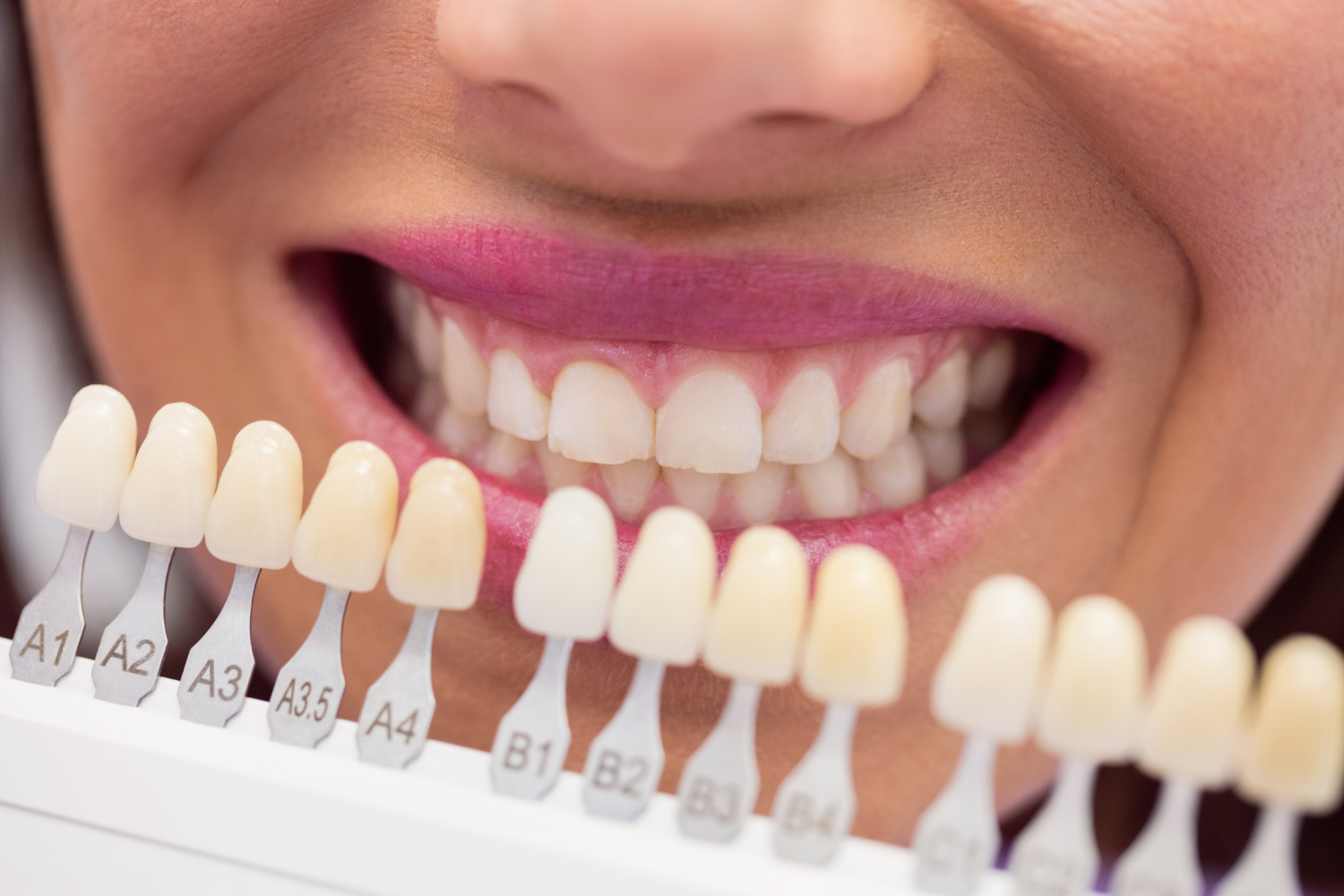 porcelain veneers life