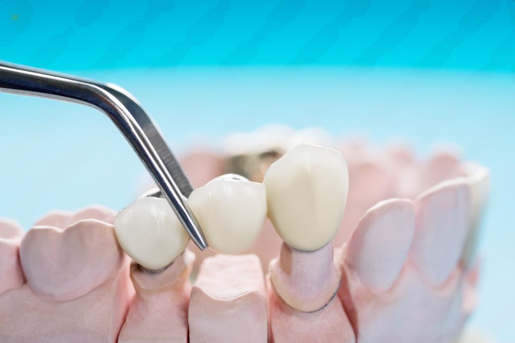 types of dental bridges near you