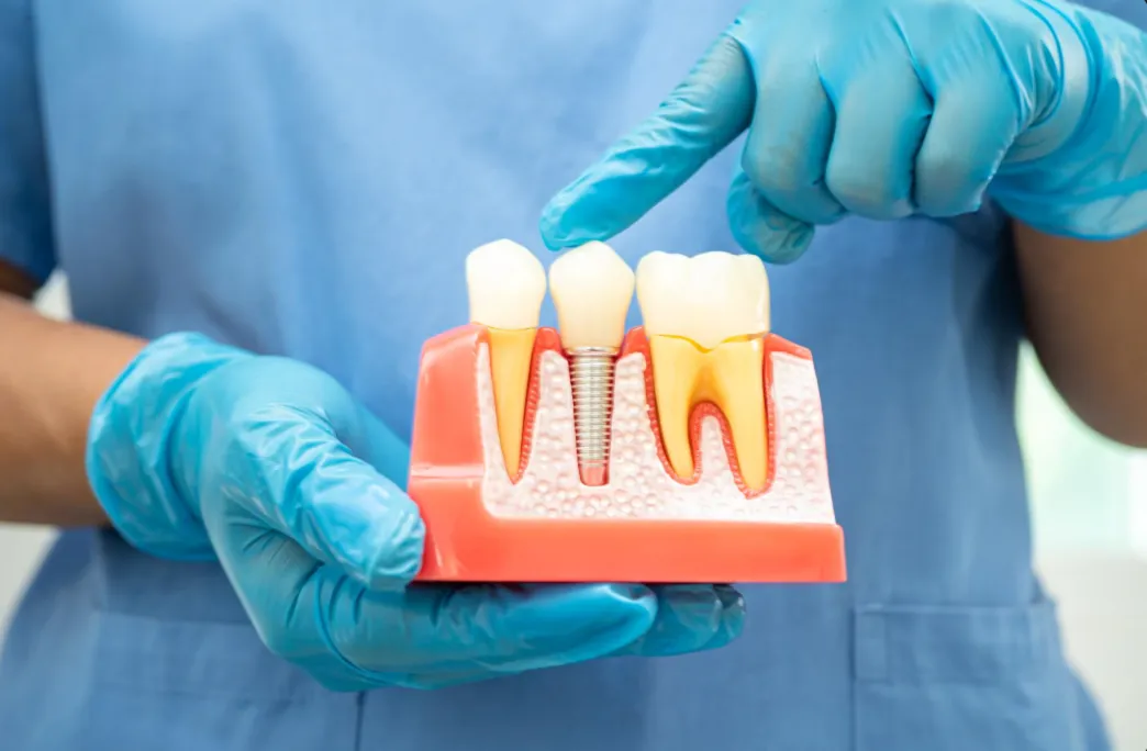 choose right dental implant material